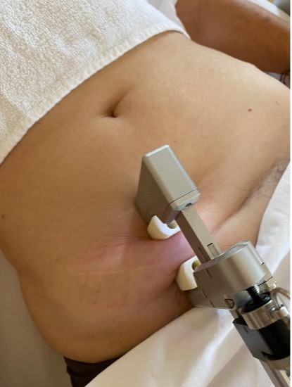 Narben Cibionic Therapie