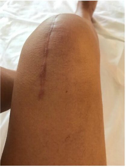 Beispiel für Narben: Längliche Narbe am Bein, die sich vom Oberschenkel bis über das Knie zieht