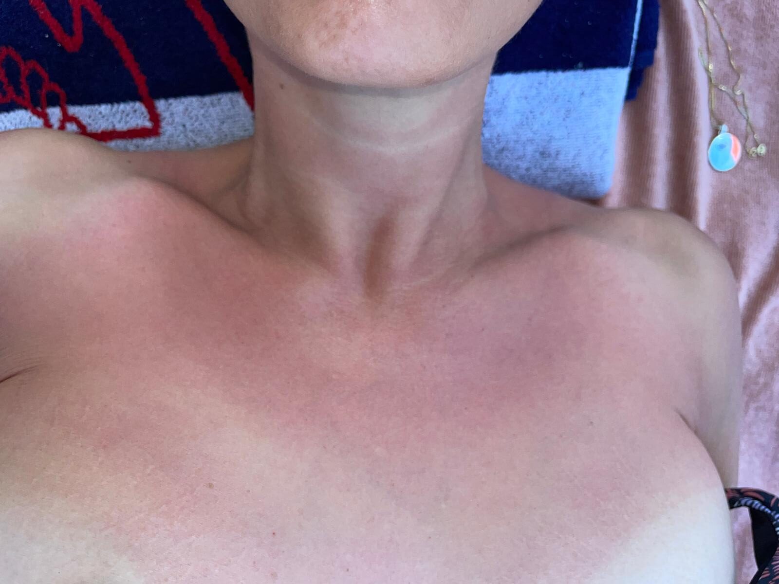UV-Schäden im Dekolleté einer Frau, die auf einem Handtuch liegt