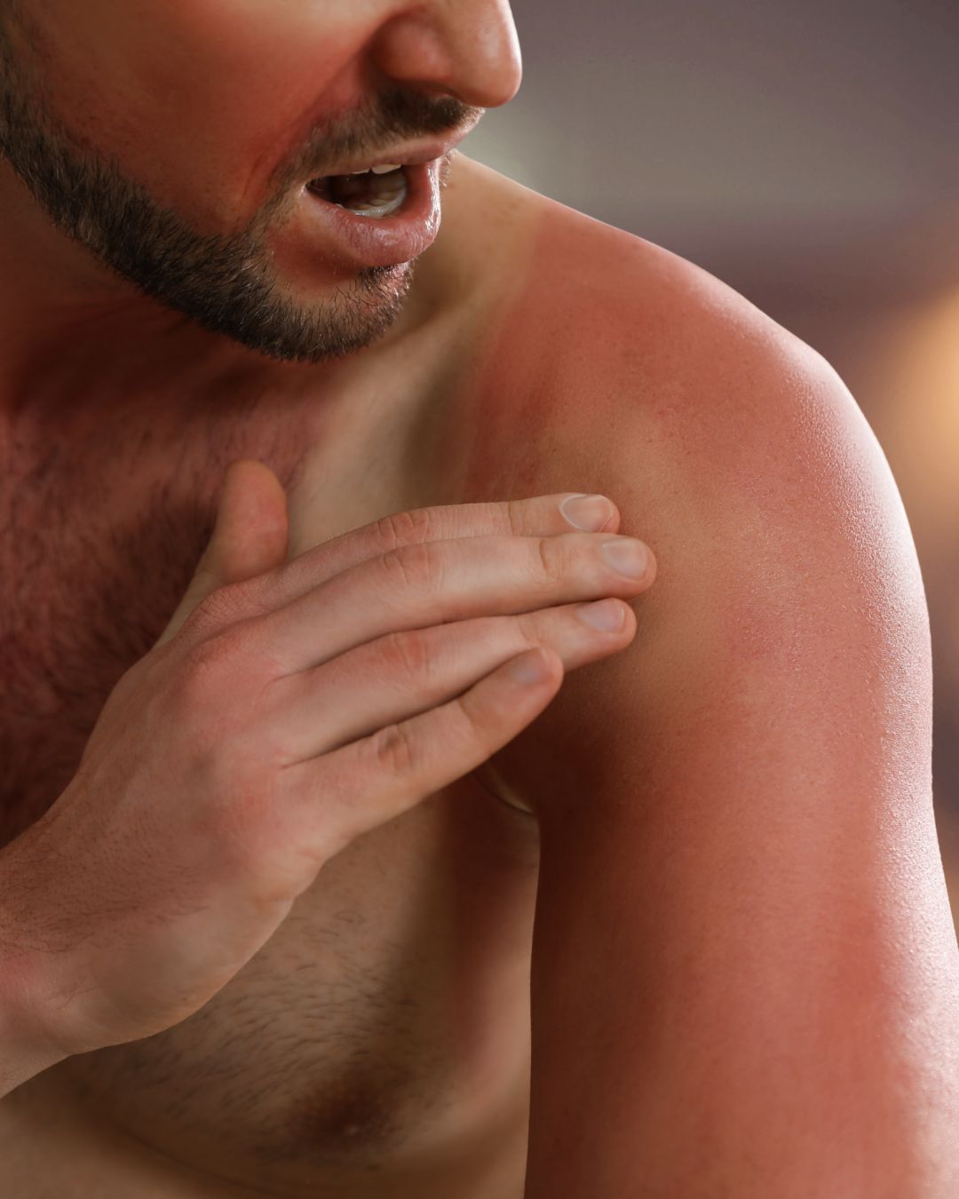 UV Schäden auf der Schulter eines Mannes, der mit der Hand auf die Haut drückt, wo sie weiße Spuren auf der roten Haut hinterlässt