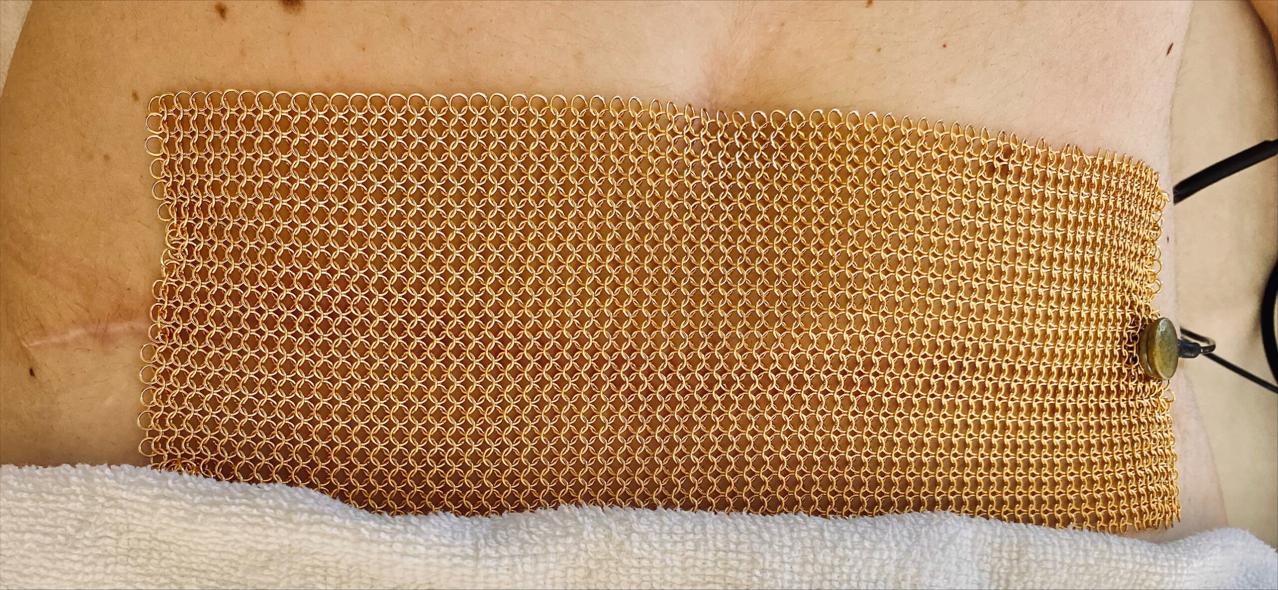 Innovative Narbenbehandlung: Goldnetzmaske bedeckt eine Kaiserschnittnarbe