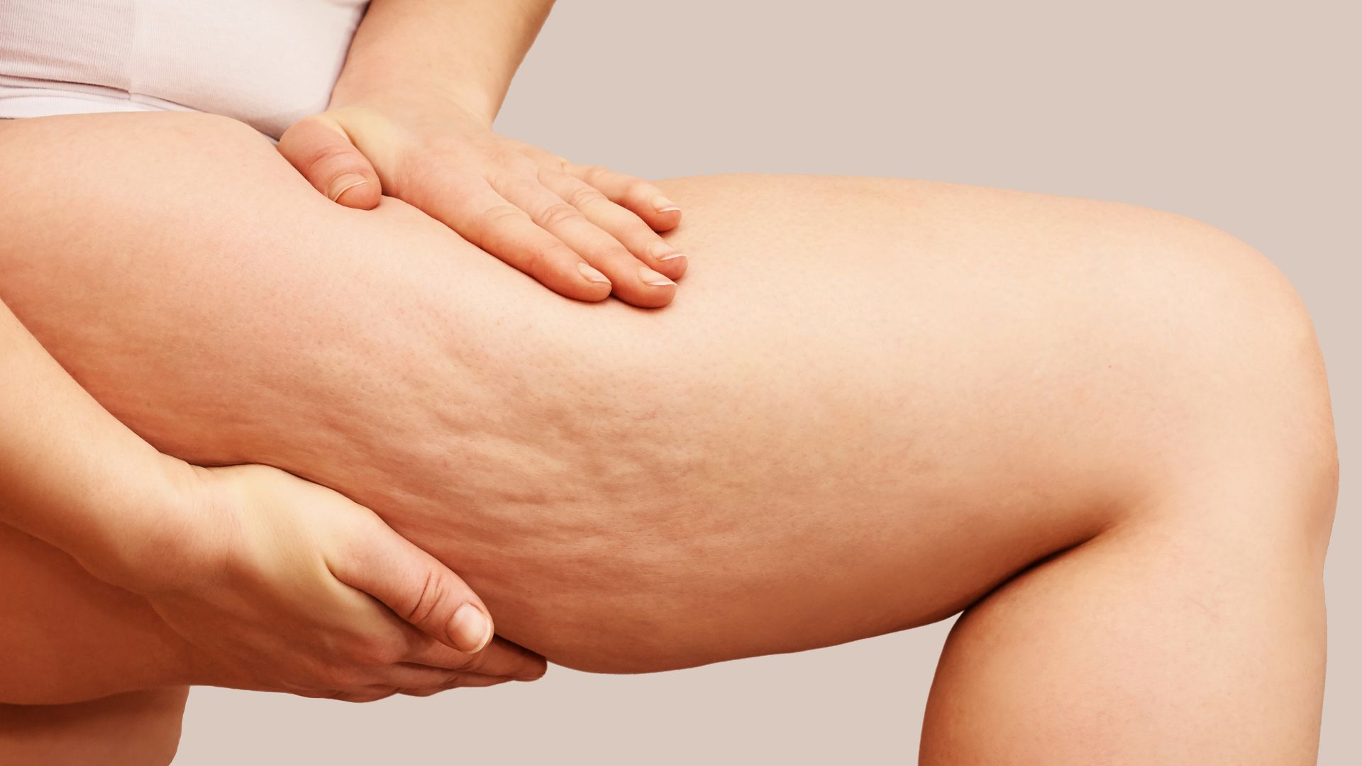 Eine Frau drückt den Oberschenkel ihres angewinkelten Beines zusammen, sodass Cellulite sichtbar wird