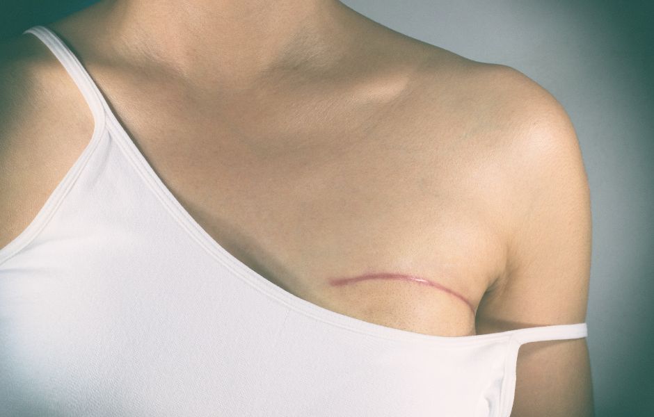 Frau mit sichtbarer Narbe an der Brust nach einer Brustoperation als Beispiel für Narbengewebe und Veränderungen im Zusammenhang mit Brustgesundheit